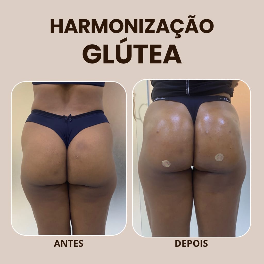 Harmonização Glútea — antes e depois na VIDEN