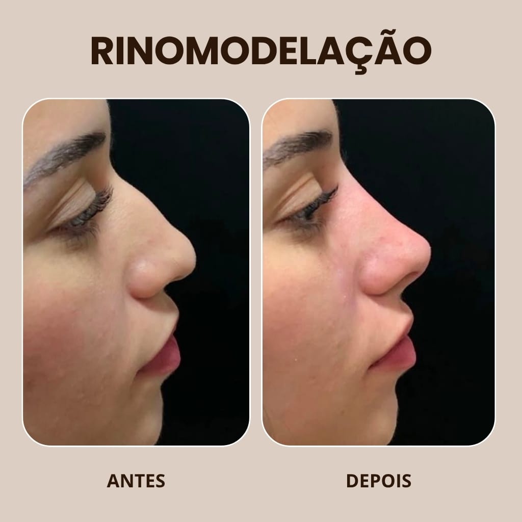 Rinomodelação — antes e depois na VIDEN