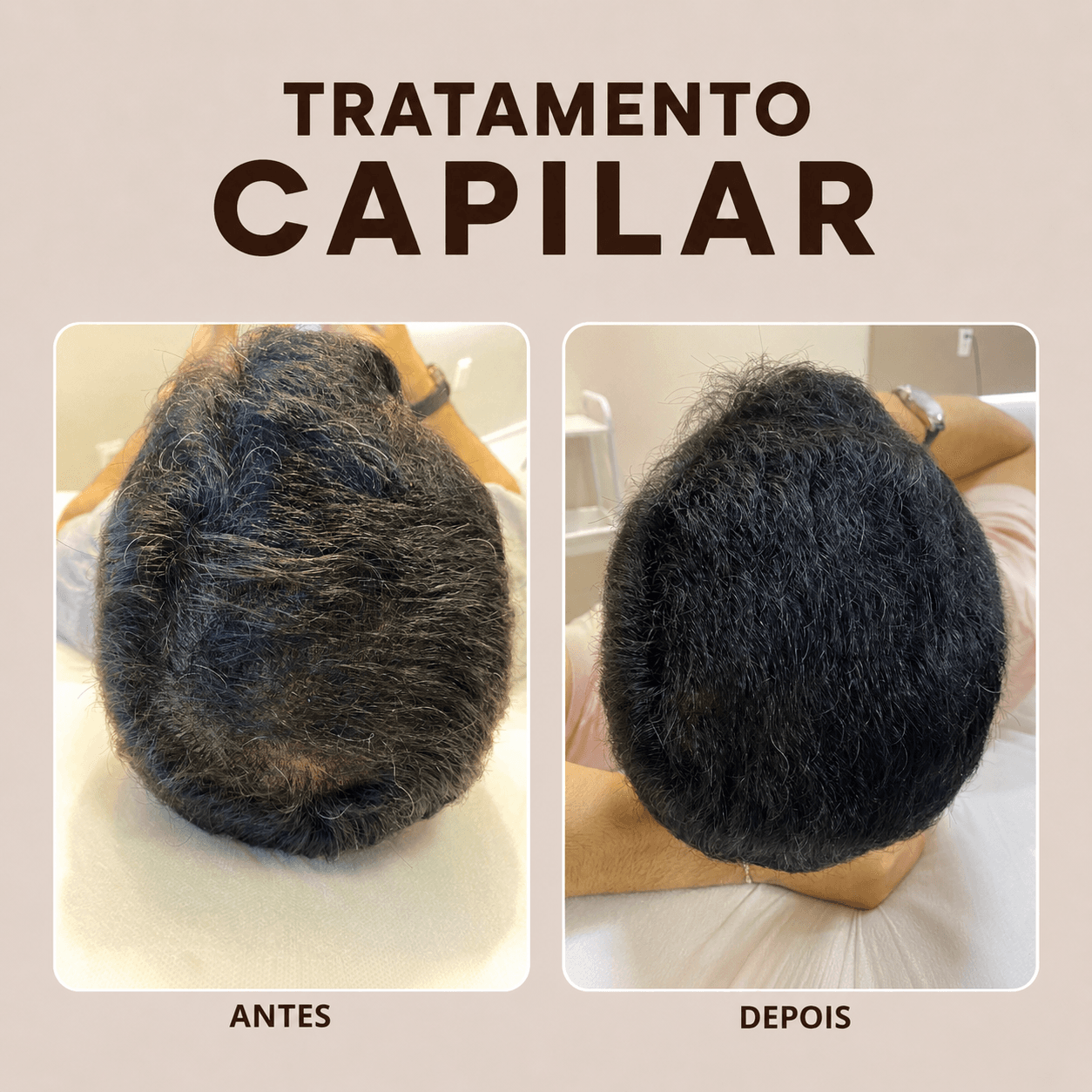 Tratamento Capilar — antes e depois na VIDEN